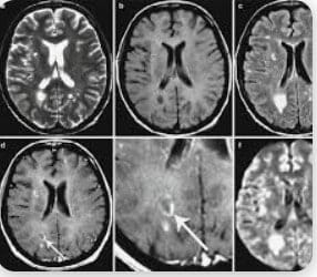 Featured image for “Demyelination and Demyelinating Disease”