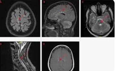 Featured image for “AI tool effectively measures MS disease activity from 1 MRI scan”