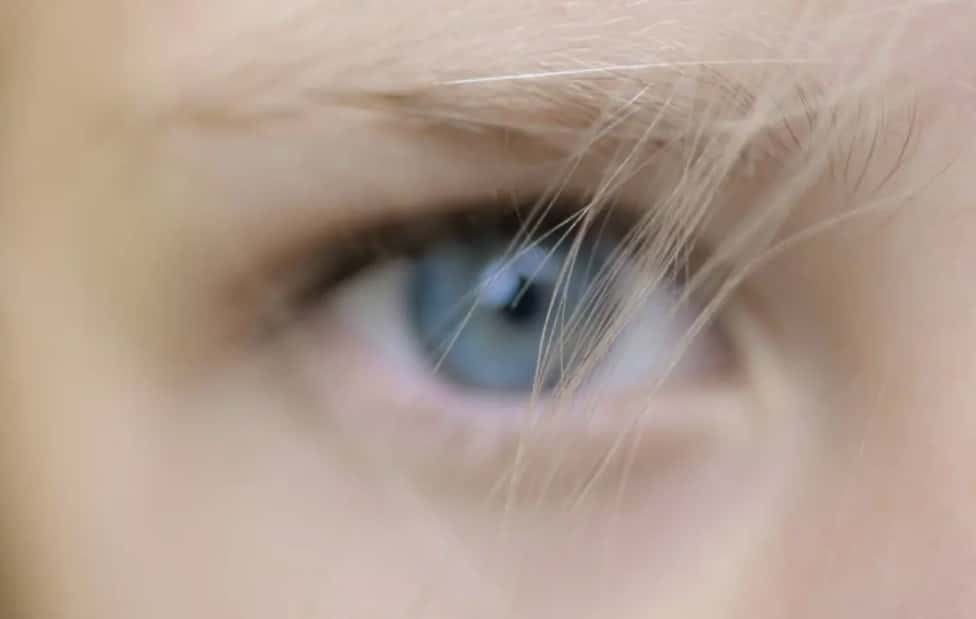 Featured image for “Uhthoff’s phenomenon”